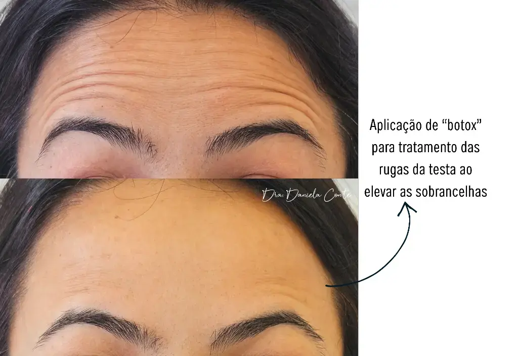 Resultado: Toxina Botulínica