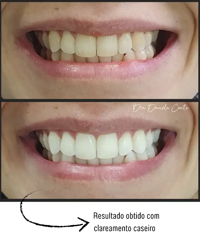 Clareamento dental