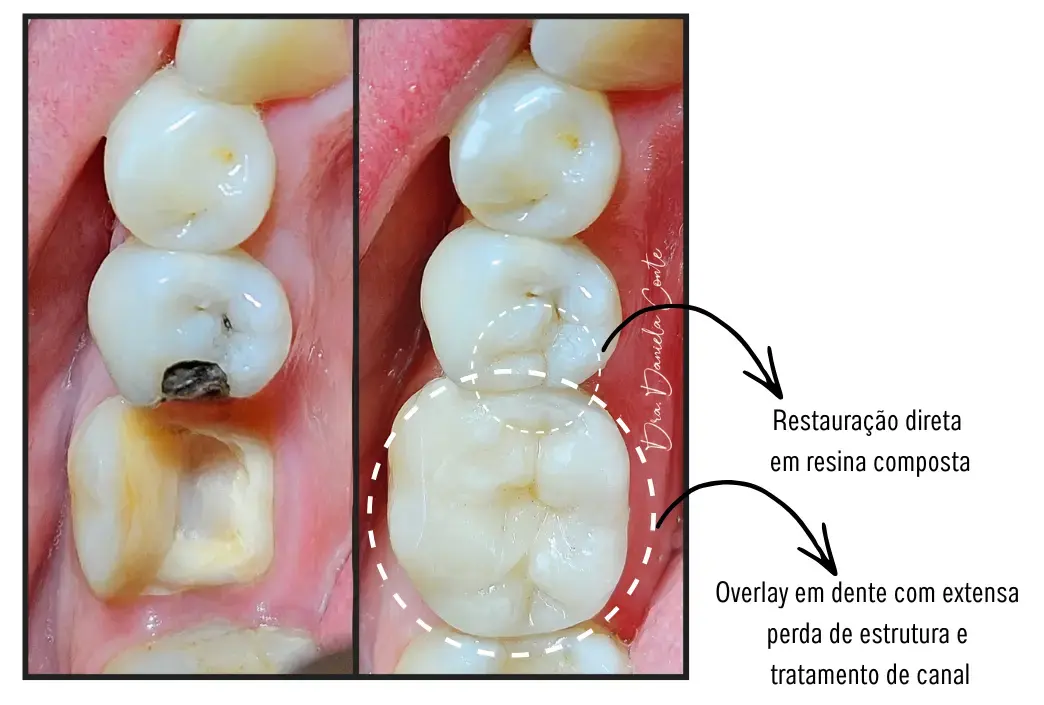 Meu dente quebrou, e agora?