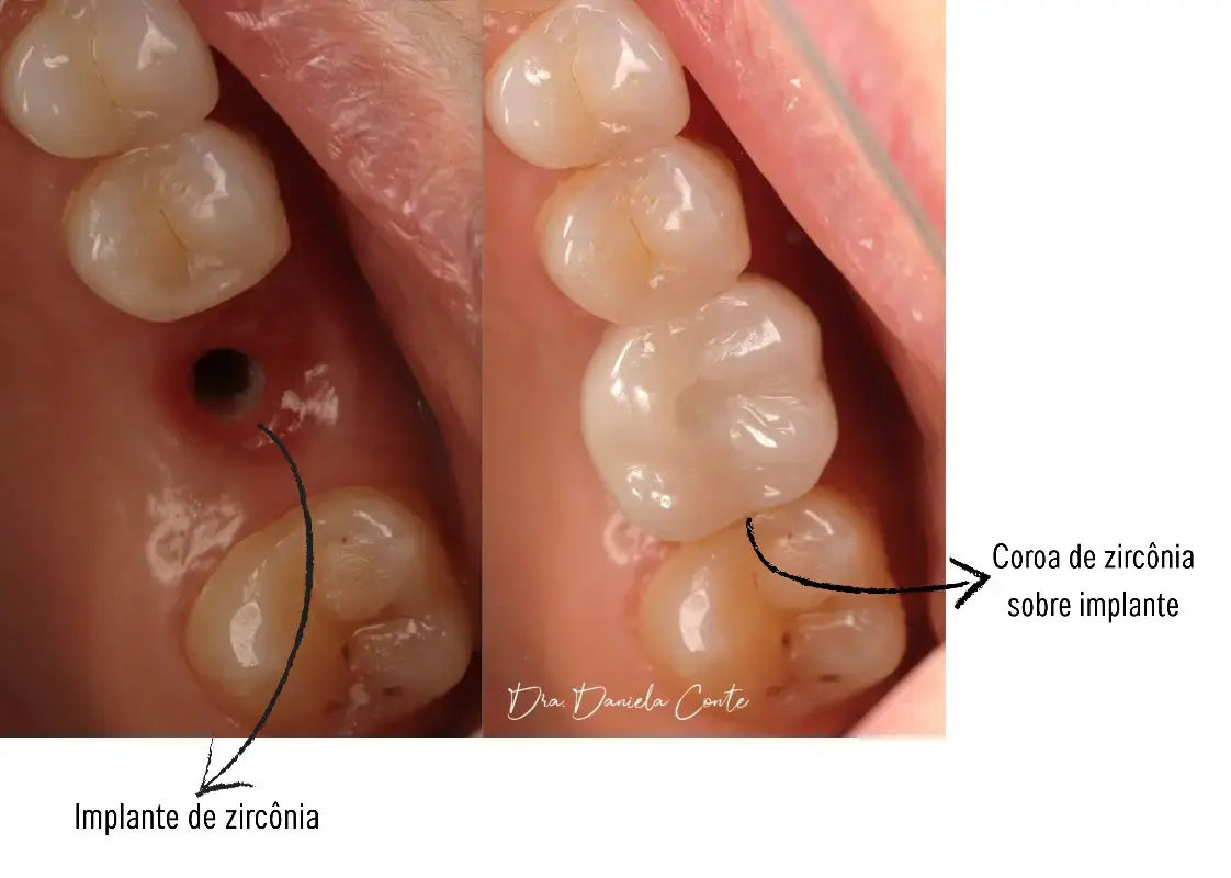 Resultado: Implantes de Zircônia